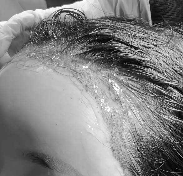 通过 EGF 护理使伤口快速愈合