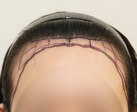 整形外科医生分析个人的比例和形状并定制设计