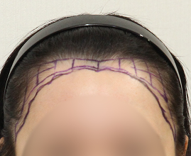 整形外科医生分析个人的比例和形状并定制设计