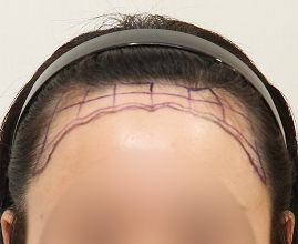 整形外科医生分析个人的比例和形状并定制设计