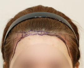 整形外科医生分析个人的比例和形状并定制设计