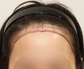 整形外科医生分析个人的比例和形状并定制设计