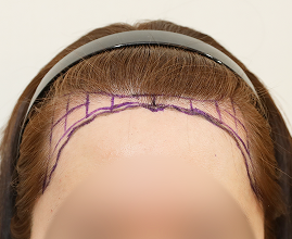 整形外科医生分析个人的比例和形状并定制设计