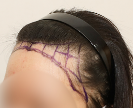 整形外科医生分析个人的比例和形状并定制设计