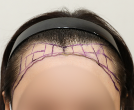 整形外科医生分析个人的比例和形状并定制设计