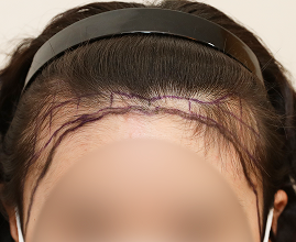 整形外科医生分析个人的比例和形状并定制设计