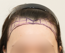 整形外科医生分析个人的比例和形状并定制设计