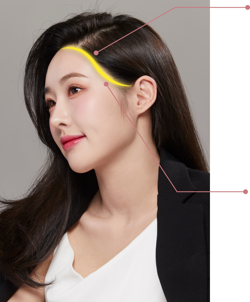 打造自然立体的脸部
**S线发际线矫正**