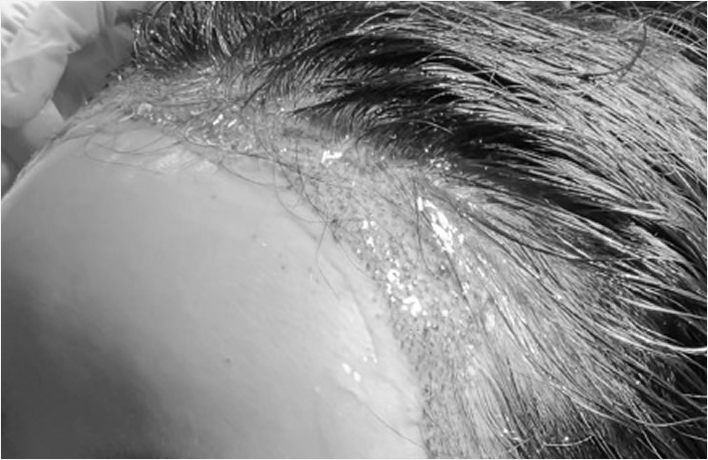 发际线矫正术后,使用EGF成分凝胶和植入喷雾快速去除疤痕组织。
有助于干净地愈合并快速缓解红肿,帮助快速恢复日常生活。