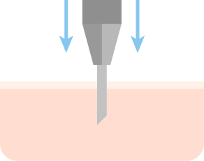 在移植部位slit打造毛孔