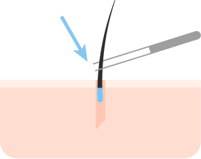 将移植毛囊插入毛孔