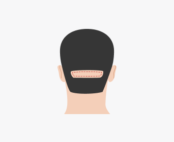 절개 헤어라인교정