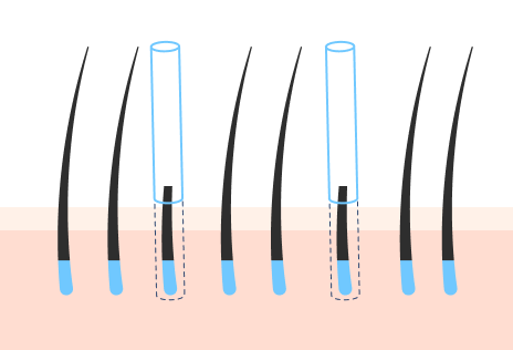 术前切割非切开