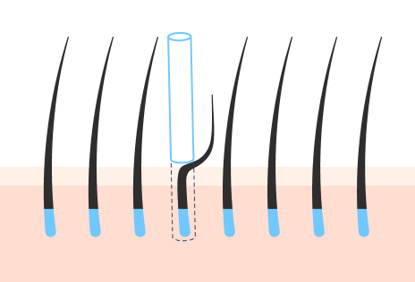 完全不剃发非切开