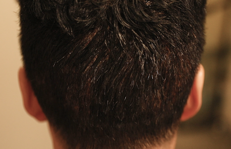 手术后第二天（洗发后）