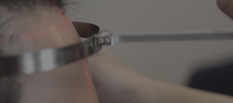 毛发移植（发际线矫正）